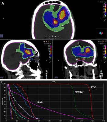 Role of Hyperbaric Oxygenation Plus Hypofractionated Stereotactic Radiotherapy in Recurrent High-Grade Glioma